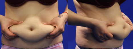 抽脂減肥瘦小腹 終于可以不用節(jié)食鍛煉了