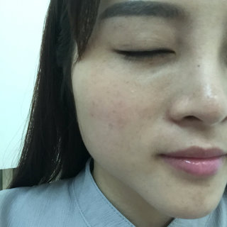 做了高強度聚焦超聲除皺小細紋都沒有啦 大家快來圍觀啊