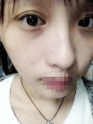 割雙眼皮恢復(fù)過程圖