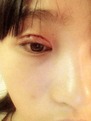 雙眼皮恢復(fù)過程經(jīng)歷