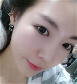 埋線雙眼皮修復(fù)+鼻部修復(fù)歷程