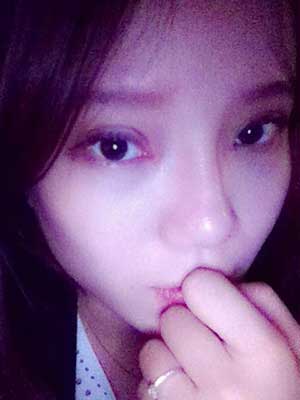 割雙眼皮半個月了 有雙眼皮的感覺真爽！