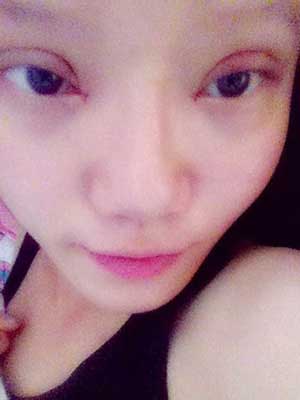 割雙眼皮半個月了 有雙眼皮的感覺真爽！