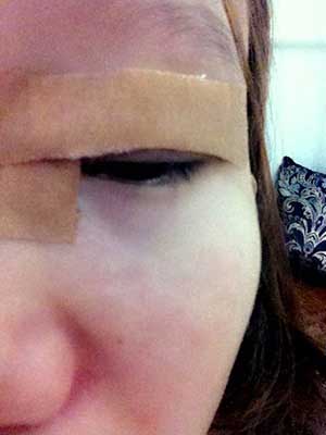 割雙眼皮半個月了 有雙眼皮的感覺真爽！