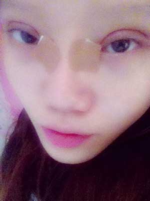 割雙眼皮半個月了 有雙眼皮的感覺真爽！