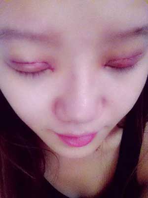 割雙眼皮半個月了 有雙眼皮的感覺真爽！