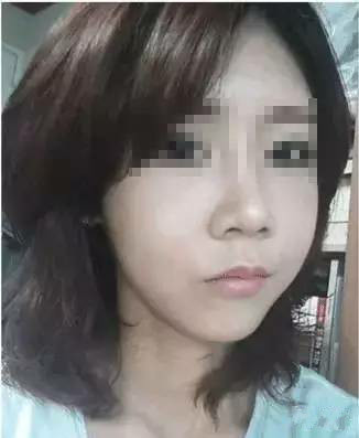 隆鼻+面部填充手術20天康復記錄