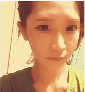 隆鼻+面部填充手術20天康復記錄