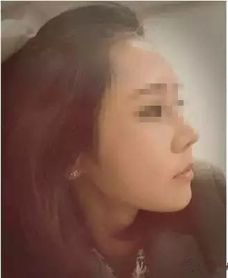 隆鼻+面部填充手術20天康復記錄