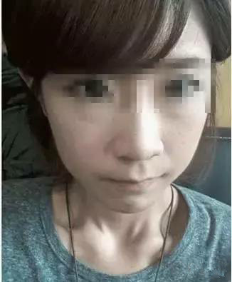 隆鼻+面部填充手術20天康復記錄