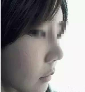 隆鼻+面部填充手術20天康復記錄