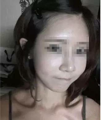 隆鼻+面部填充手術20天康復記錄