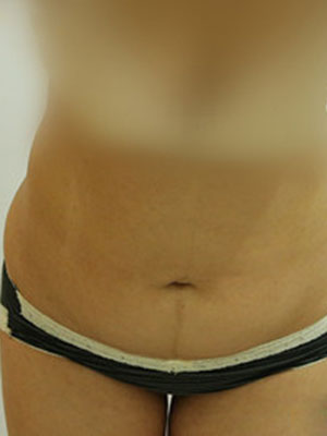 腰部吸脂 水桶腰變成小蠻腰啦