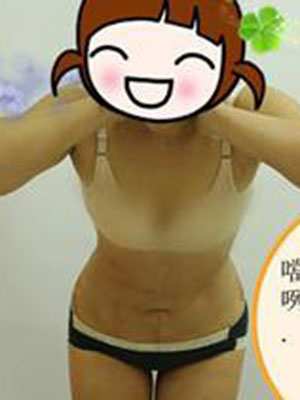 腰部吸脂 水桶腰變成小蠻腰啦