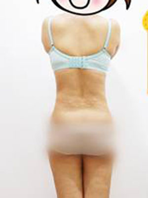 腰部吸脂 水桶腰變成小蠻腰啦