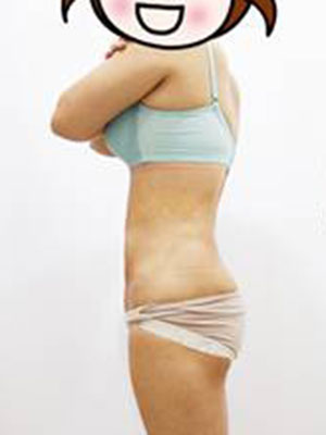 腰部吸脂 水桶腰變成小蠻腰啦