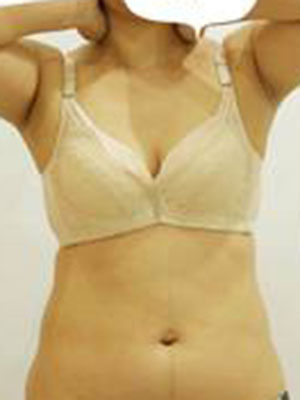 腰部吸脂 水桶腰變成小蠻腰啦