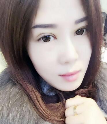 雙眼皮恢復(fù)記錄 果很滿意~