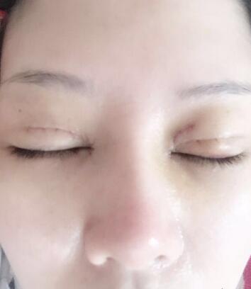 雙眼皮恢復(fù)記錄 果很滿意~