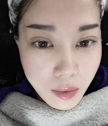 雙眼皮恢復(fù)記錄 果很滿意~