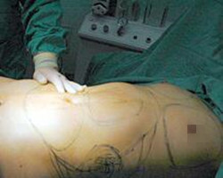 我在北京藝星醫(yī)療美容醫(yī)院自體脂肪隆胸真實(shí)經(jīng)歷