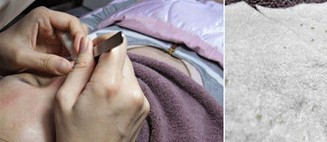 成都玉之光做了杏仁酸換膚 皮膚真的凈白無瑕了