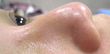 成都玉之光做了杏仁酸換膚 皮膚真的凈白無瑕了