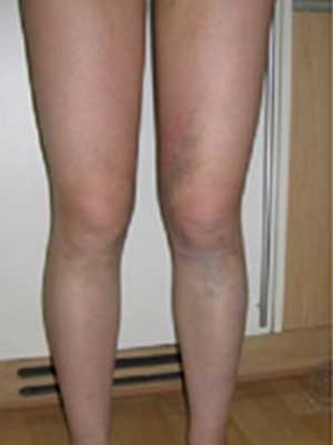 北京禾美嘉大腿吸脂 給大家分享一下體驗(yàn)