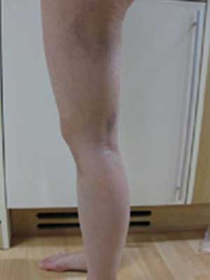 北京禾美嘉大腿吸脂 給大家分享一下體驗(yàn)