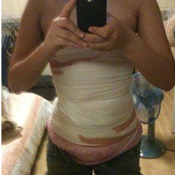 北京禾美嘉腹部吸脂 可以自信地秀出小蠻腰啦！