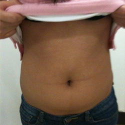 北京禾美嘉腹部吸脂 可以自信地秀出小蠻腰啦！