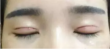 深圳希思做的雙眼皮 現(xiàn)在美美的