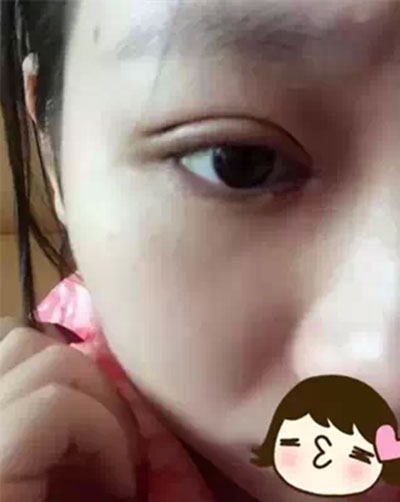 深圳希思做的雙眼皮+開眼角 感謝楊醫(yī)師！