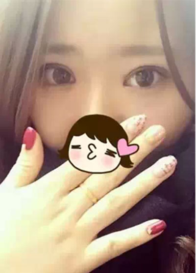 深圳希思做的雙眼皮+開眼角 感謝楊醫(yī)師！