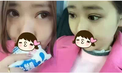 深圳希思做的雙眼皮+開眼角 感謝楊醫(yī)師！