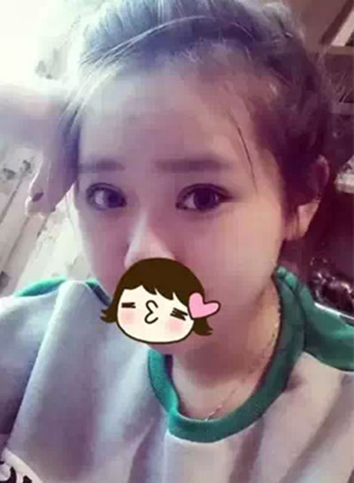 深圳希思做的雙眼皮+開眼角 感謝楊醫(yī)師！