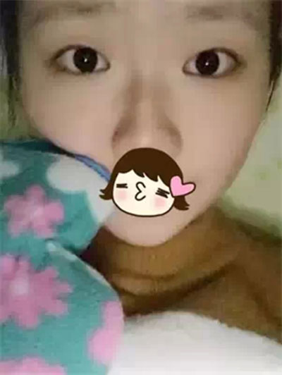 深圳希思做的雙眼皮+開眼角 感謝楊醫(yī)師！