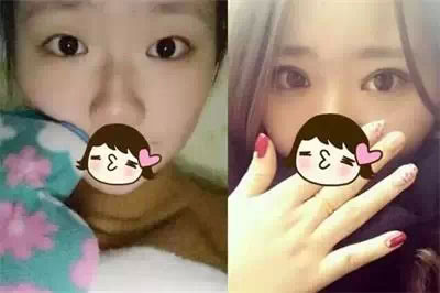 深圳希思做的雙眼皮+開眼角 感謝楊醫(yī)師！