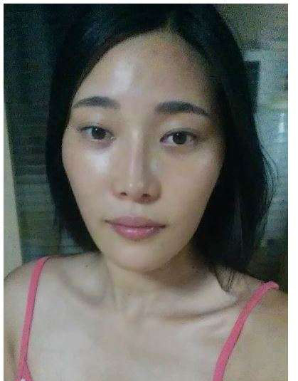 柳大烈給我做的改臉型手術(shù) 求圍觀!