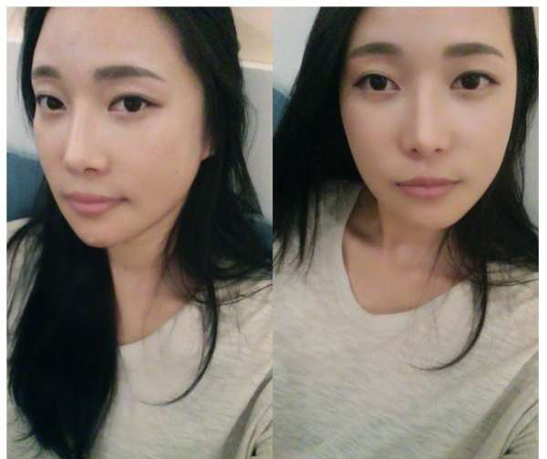 柳大烈給我做的改臉型手術(shù) 求圍觀!