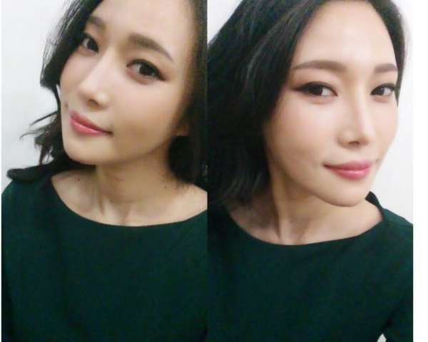 柳大烈給我做的改臉型手術(shù) 求圍觀!