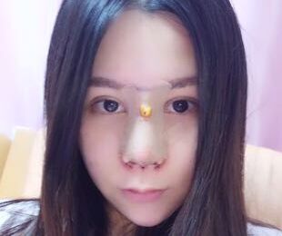 　　以前做過(guò)鼻子，但是不好看，山根那個(gè)地方太奇怪了，形狀不太協(xié)調(diào)，聽說(shuō)趙士俊醫(yī)生做鼻子修復(fù)很好，就慕名而來(lái)啦，放心的把自己的鼻子交給他，后來(lái)的果沒有讓我失望哦。    　　之前做的鼻子，奇怪吧。    　　做了手術(shù)之后打了消炎針，漏掉一天沒搭，傷口就發(fā)紅泛腫了，簡(jiǎn)直嚇人，趕緊去醫(yī)院打消炎，喝白粥度日。    　　沒拆紗布，不過(guò)感覺已經(jīng)聽好了，拆了應(yīng)該很好看的。    　　恢復(fù)得不錯(cuò)了，穿了古裝，畫了個(gè)美美的妝，完全沒有違和感。