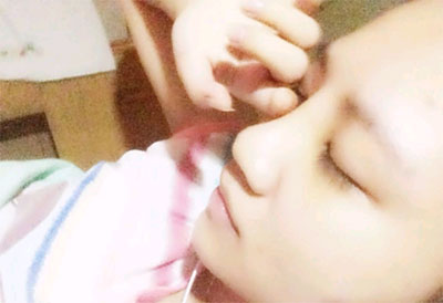 假體隆鼻15天后恢復(fù)果 杭州時光做的~