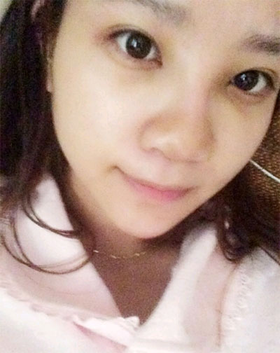 假體隆鼻15天后恢復(fù)果 杭州時光做的~