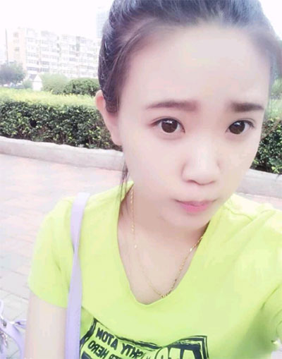 假體隆鼻15天后恢復(fù)果 杭州時光做的~