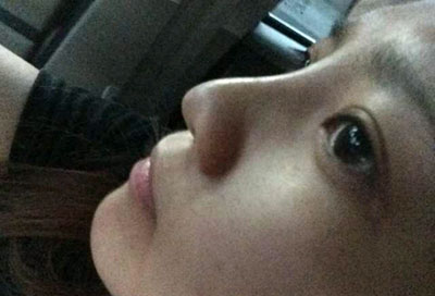 假體隆鼻15天后恢復(fù)果 杭州時光做的~