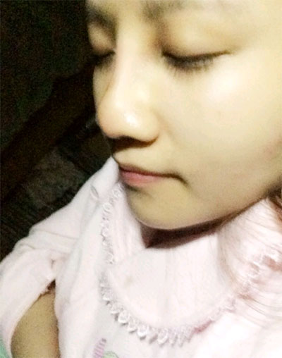 假體隆鼻15天后恢復(fù)果 杭州時光做的~