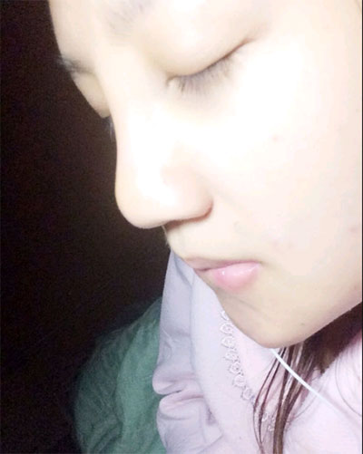 假體隆鼻15天后恢復(fù)果 杭州時光做的~