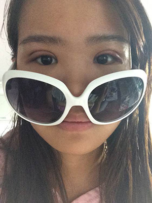 納米x雕雙眼皮15天了~ 我恢復(fù)的算快嗎