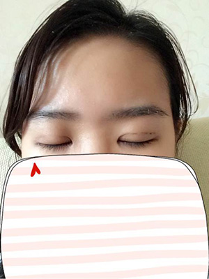 納米x雕雙眼皮15天了~ 我恢復(fù)的算快嗎